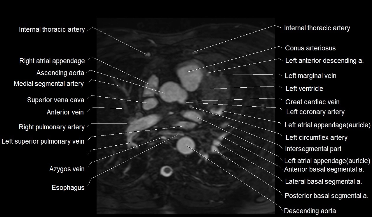 MRI heart coronary arteries and coronary veins anatomy axial image 13.webp